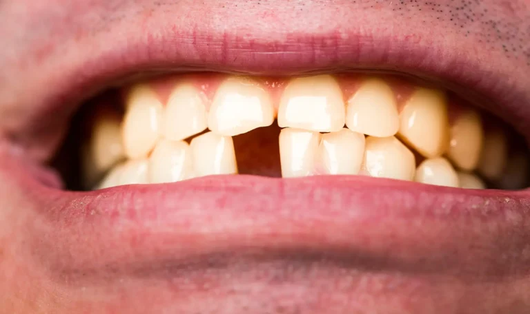Close-up of a man with a missing front tooth, highlighting the impact of tooth loss and the importance of dental implants at Montana Center for Implants and Dentures.