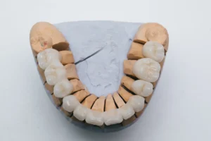 Whole mouth rehabilitation model showing ceramic dental bridges for oral damage at Montana Center for Implants and Dentures.