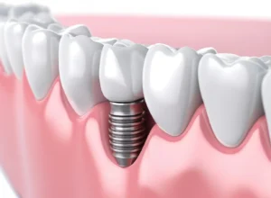 3D model depicting a dental implant integrated with the jawbone, emphasizing the importance of understanding tooth implant recovery time at Montana Center for Implants and Dentures.