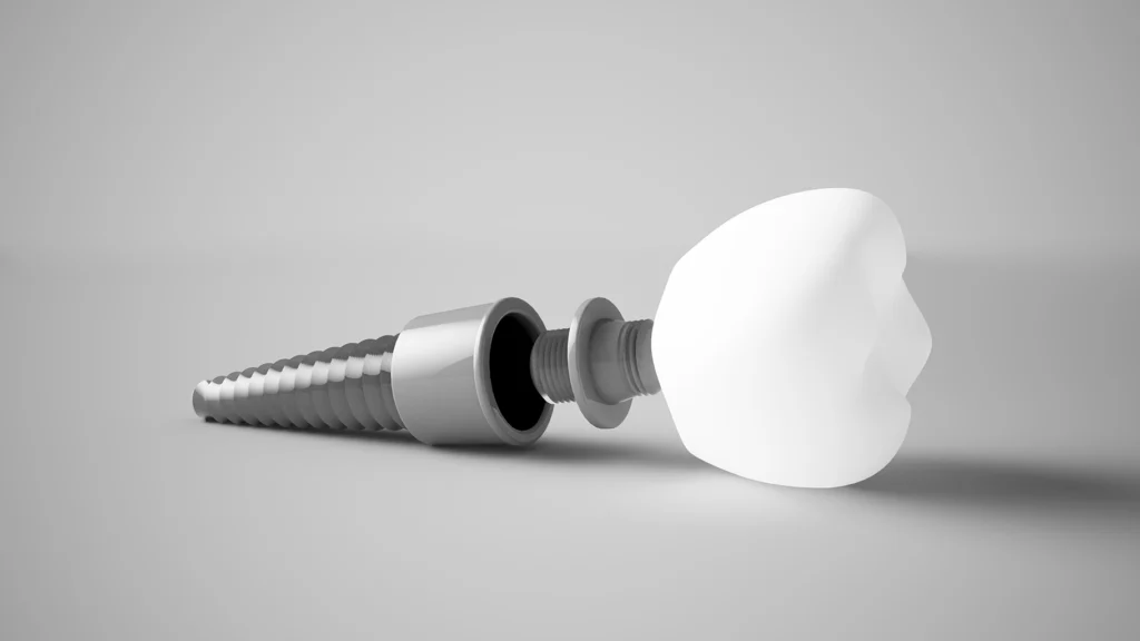 3D illustration of a dental implant and its components, highlighting the importance of bone grafting for successful procedures at Montana Center for Implants and Dentures.