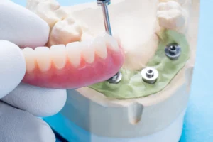 Close-up of a dental prosthetic being installed on All-On-4 Implants, illustrating cleaning and maintenance techniques, Montana Center for Implants and Dentures.