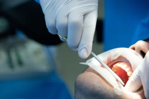 Close-up of a dentist performing oral surgery on a patient in Billings, MT, at Montana Center for Implants and Dentures.