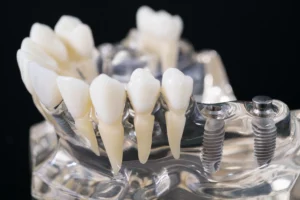 Close-up of a dental implant model showing artificial teeth and titanium posts, illustrating dental implants and potential risks like dental implant infection. Expert care available at Montana Center for Implants and Dentures.