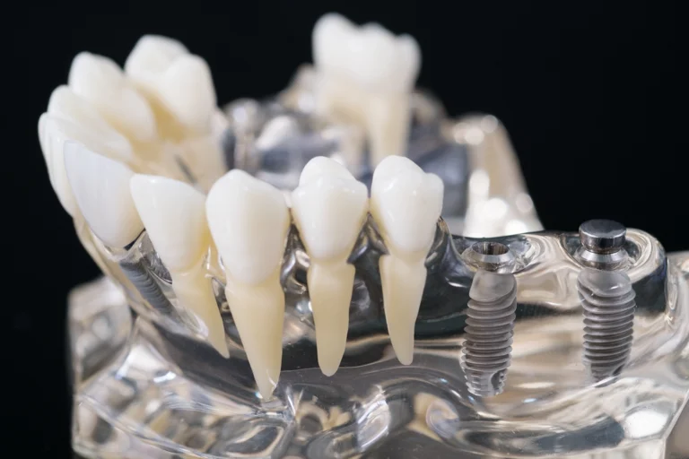 Close-up of a dental implant model showing artificial teeth and titanium posts, illustrating dental implants and potential risks like dental implant infection. Expert care available at Montana Center for Implants and Dentures.