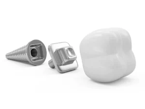 Illustration of a tooth implant, including the titanium post, abutment, and ceramic crown, explaining what are teeth implants made of. Expert dental care at Montana Center for Implants and Dentures.
