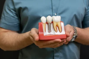 A dental professional at Montana Center for Implants and Dentures holding a model of dental implants, illustrating the healing process after oral surgery.