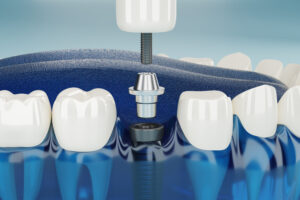 3D rendering of a dental implant being placed between natural teeth, illustrating the procedure offered at Montana Center for Implants and Dentures and representing advanced solutions and showing one of the 4 types of dental implants.
