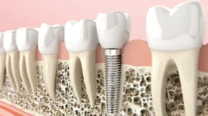 3D illustration of a dental implant placed in the jawbone, used by Montana Center for Implants and Dentures to explain what is a bone graft and how it supports successful dental implants.