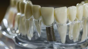 Close-up of a model showing bottom dental implants inserted into the jawbone, demonstrating implant treatment options available at Montana Center for Implants and Dentures.