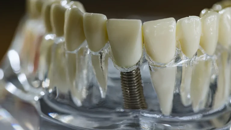 Close-up of a model showing bottom dental implants inserted into the jawbone, demonstrating implant treatment options available at Montana Center for Implants and Dentures.