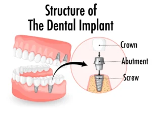 Illustration showing the crown, dental implant abutment, and screw components, provided by Montana Center for Implants and Dentures.