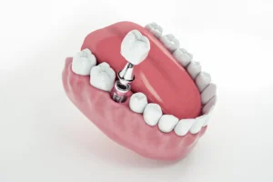 3D illustration of a dental implant inserted into the lower jaw, used to explain what happens if a dental implant fails at Montana Center for Implants and Dentures.
