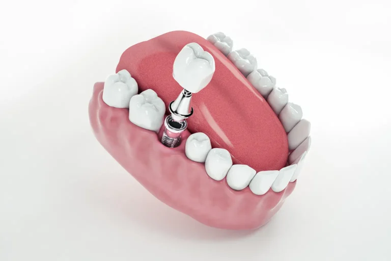 3D illustration of a dental implant inserted into the lower jaw, used to explain what happens if a dental implant fails at Montana Center for Implants and Dentures.