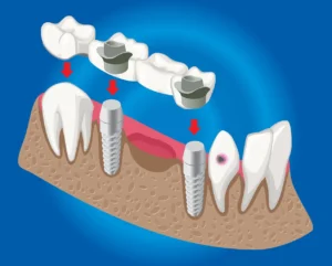 Illustration showing how snap-in dentures attach to dental implants for a secure fit.