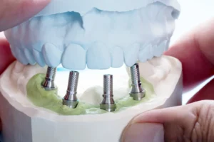 Close-up of dental model showing All-on-4® implants vs traditional implants, illustrating the placement of four titanium posts for full arch restoration.