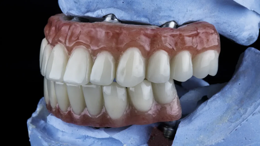 Close-up of a full arch prosthetic showing the benefits of All-on-4 implants on a blue plaster model.