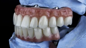 Close-up of a full arch prosthetic showing the benefits of All-on-4 implants on a blue plaster model.