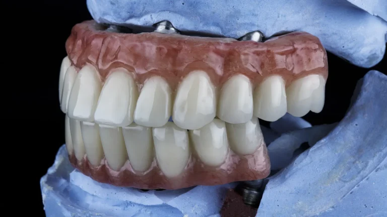 Close-up of a full arch prosthetic showing the benefits of All-on-4 implants on a blue plaster model.
