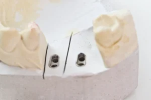 Close-up of gypsum jaw model showing bone grafting for dental implants preparation.